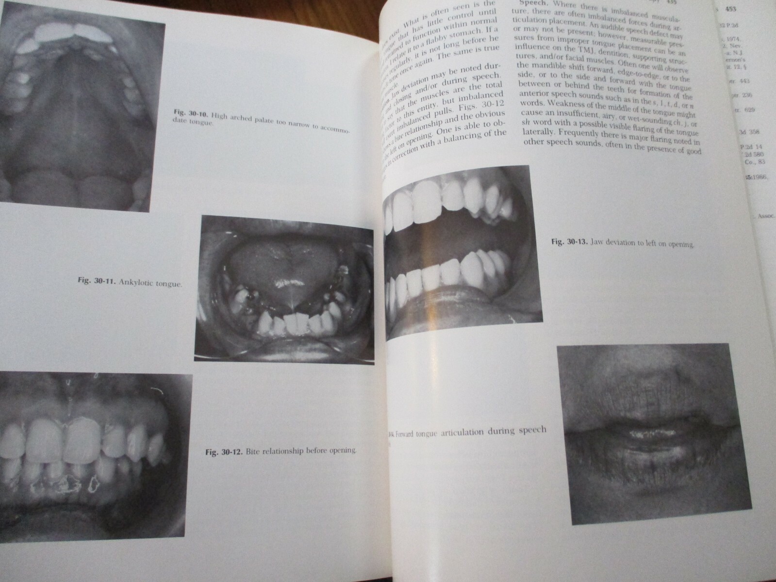 Diseases of the Tempormandibular Apparatus : A Multidisciplinary Approach 1977