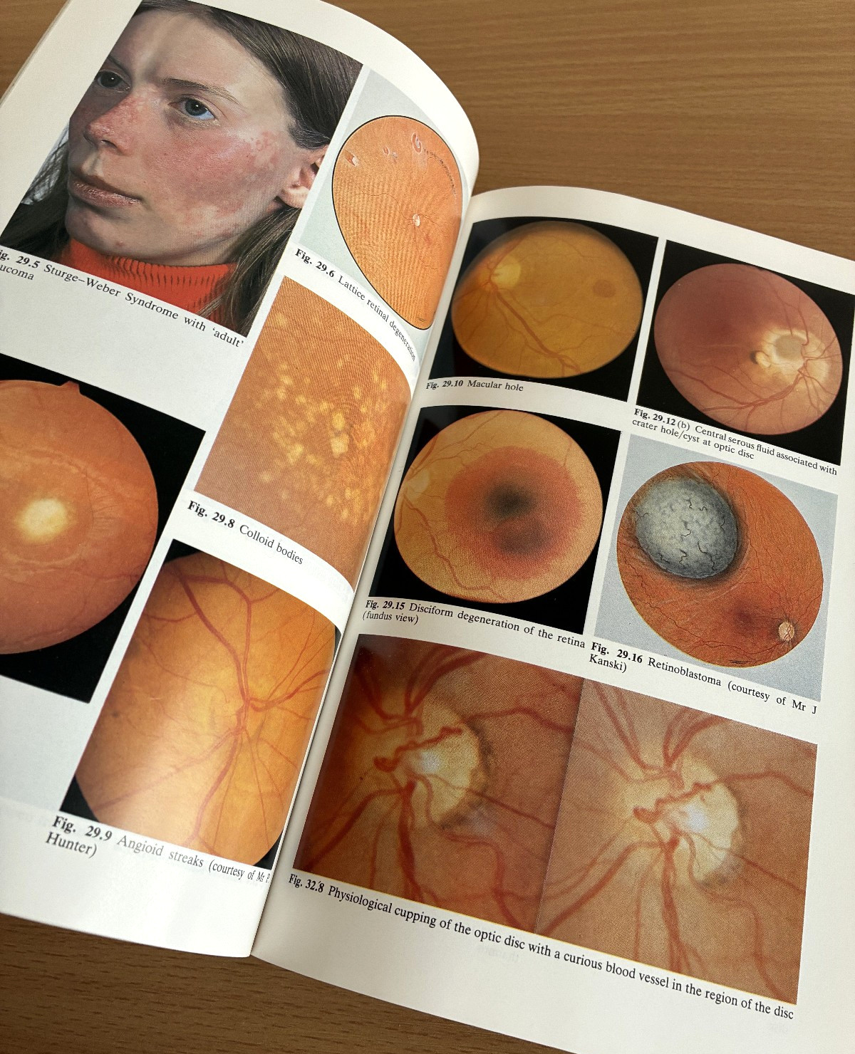 A Textbook Of Clinical Ophthalmology Crick Trimble 1986 Hodder & Stoughton 1st