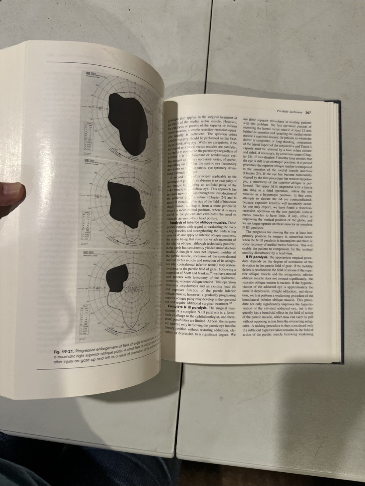 Binocular Vision And Ocular Motility. Von Noorden. 1985. Ophthalmology