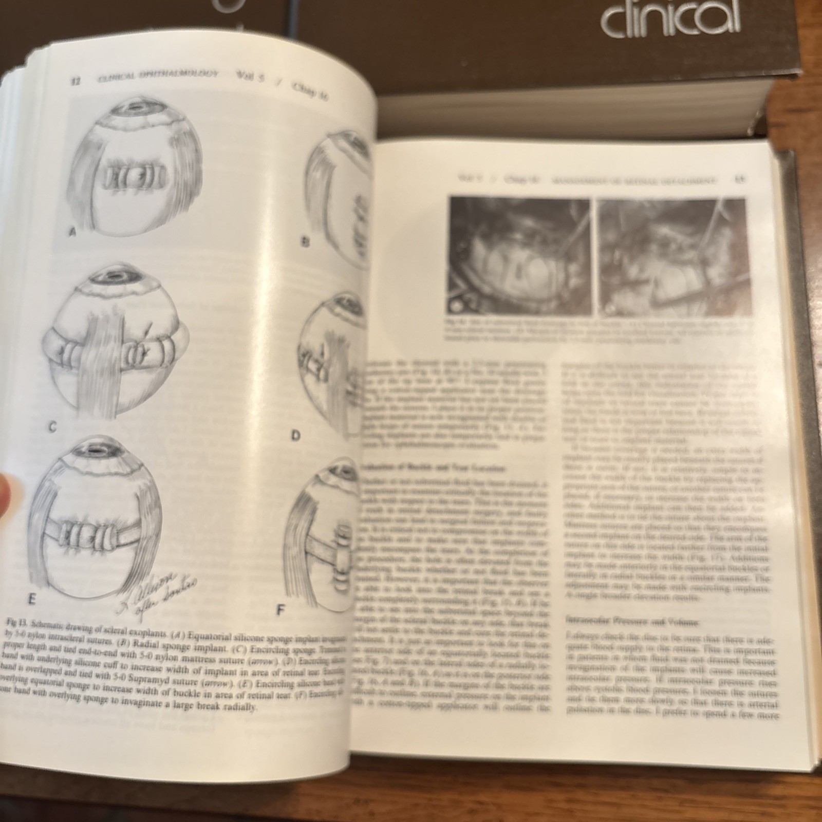 Duane’s Clinical Ophthalmology Book Set 1 2 3 4 5 Thomas D. Duane 1994