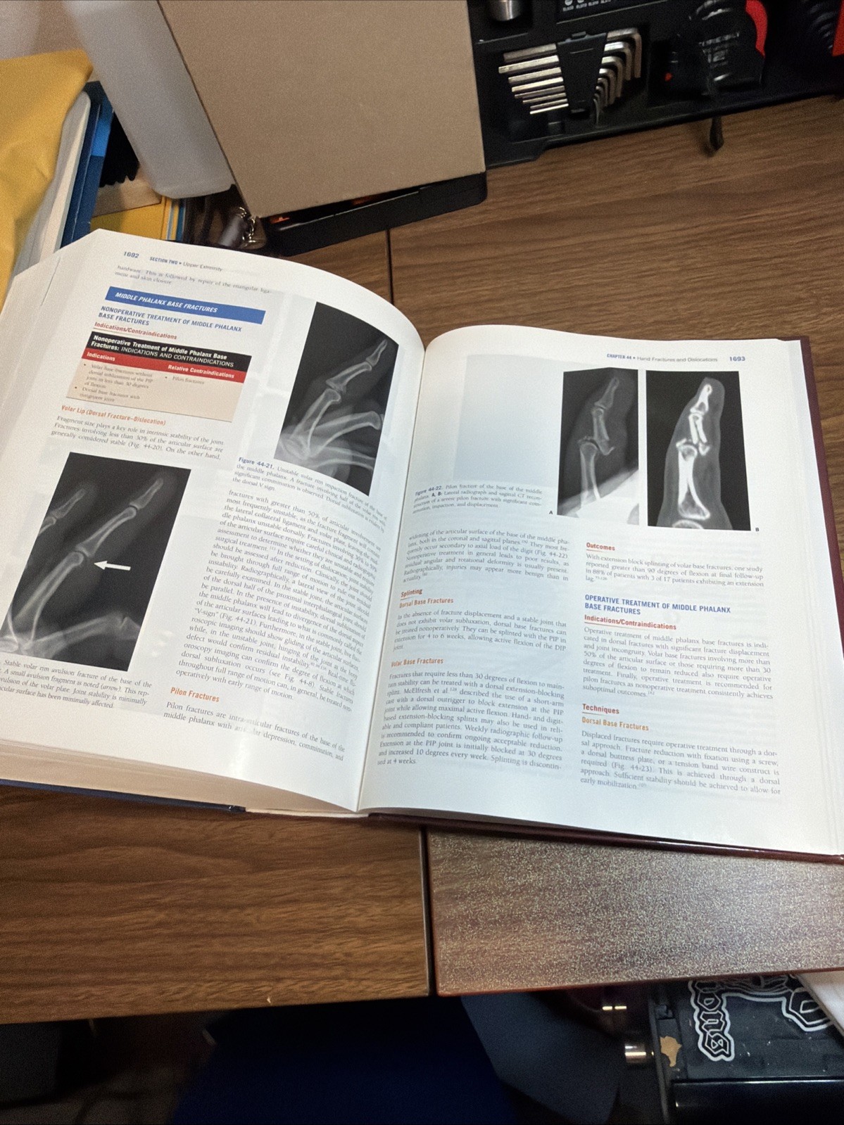 Rockwood and Green’s Fractures In Adults Volume 1 Ninth Edition Textbook