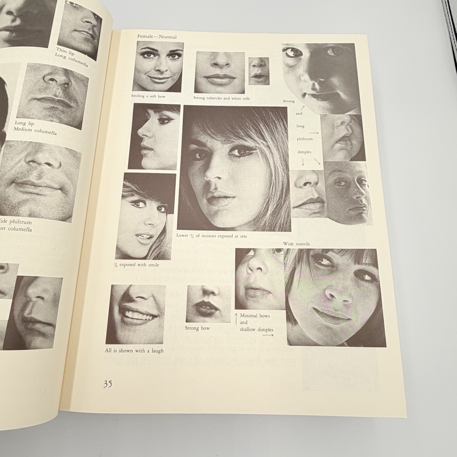Cleft Craft Vol 2 Evolution Of Its Surgery The Unilateral Deformity Millard 1977