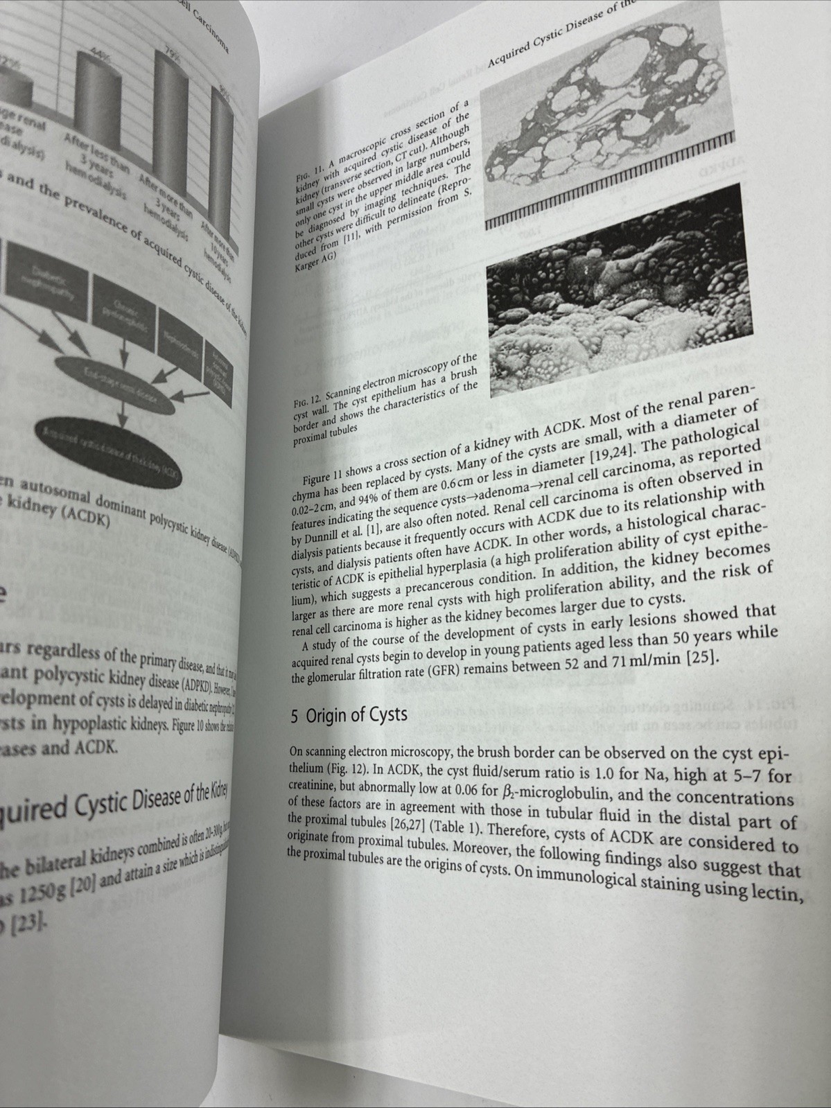 Acquired Cystic Disease of the Kidney and Renal Cell Carcinoma: Complication of
