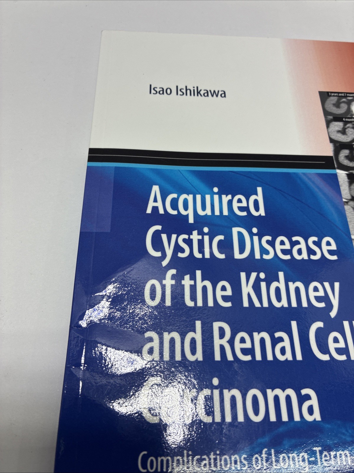 Acquired Cystic Disease of the Kidney and Renal Cell Carcinoma: Complication of