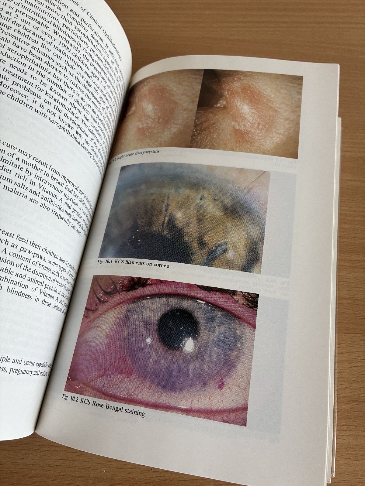 A Textbook Of Clinical Ophthalmology Crick Trimble 1986 Hodder & Stoughton 1st