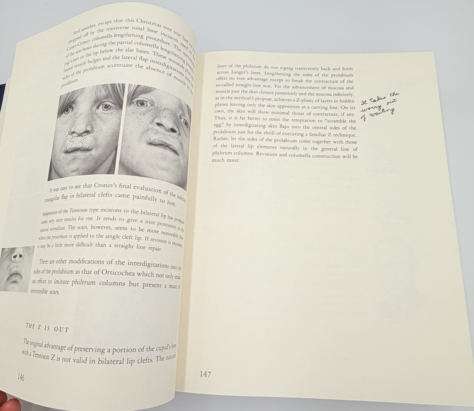 Cleft Craft Vol 2 Evolution Of Its Surgery The Unilateral Deformity Millard 1977