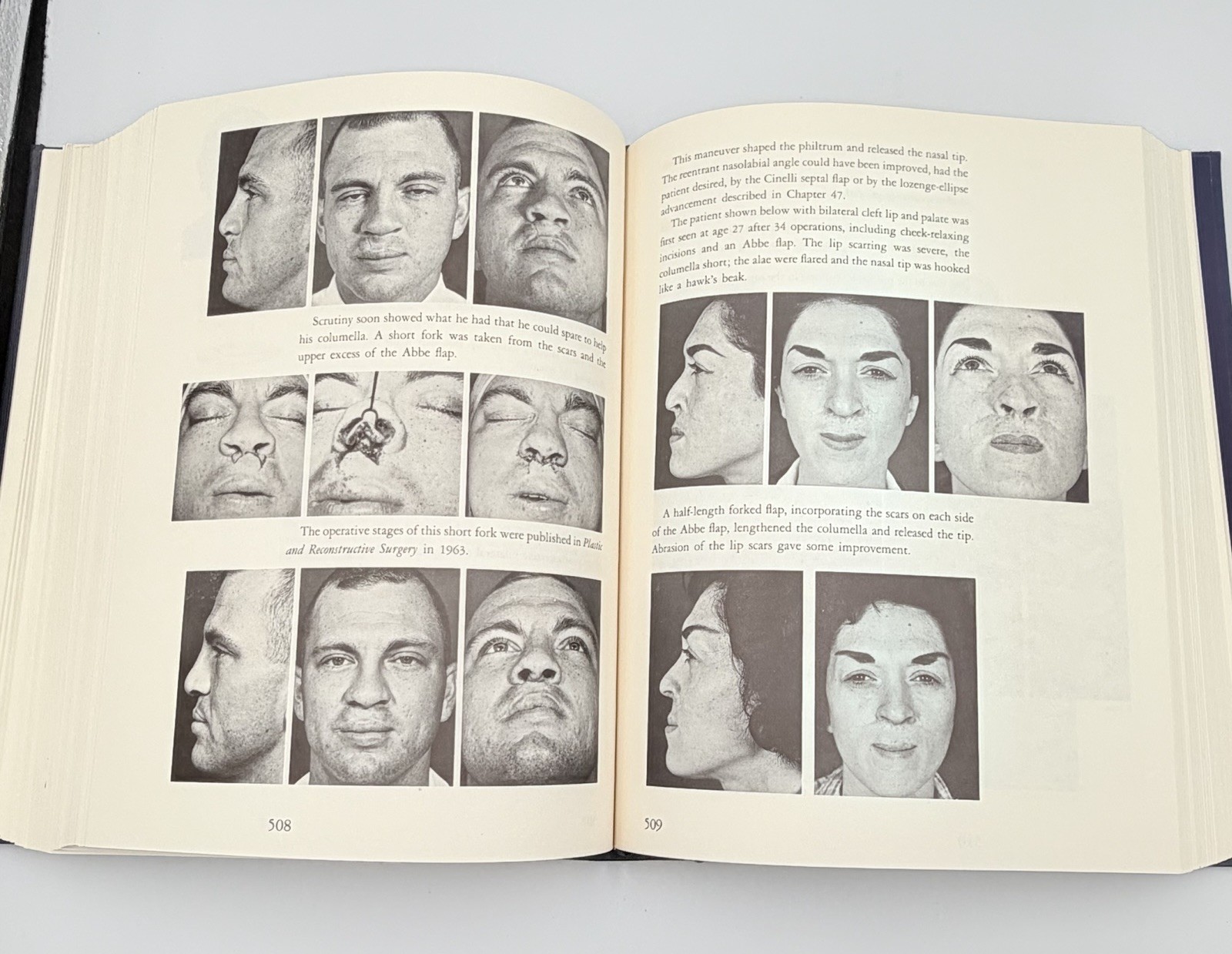 Cleft Craft Vol 2 Evolution Of Its Surgery The Unilateral Deformity Millard 1977