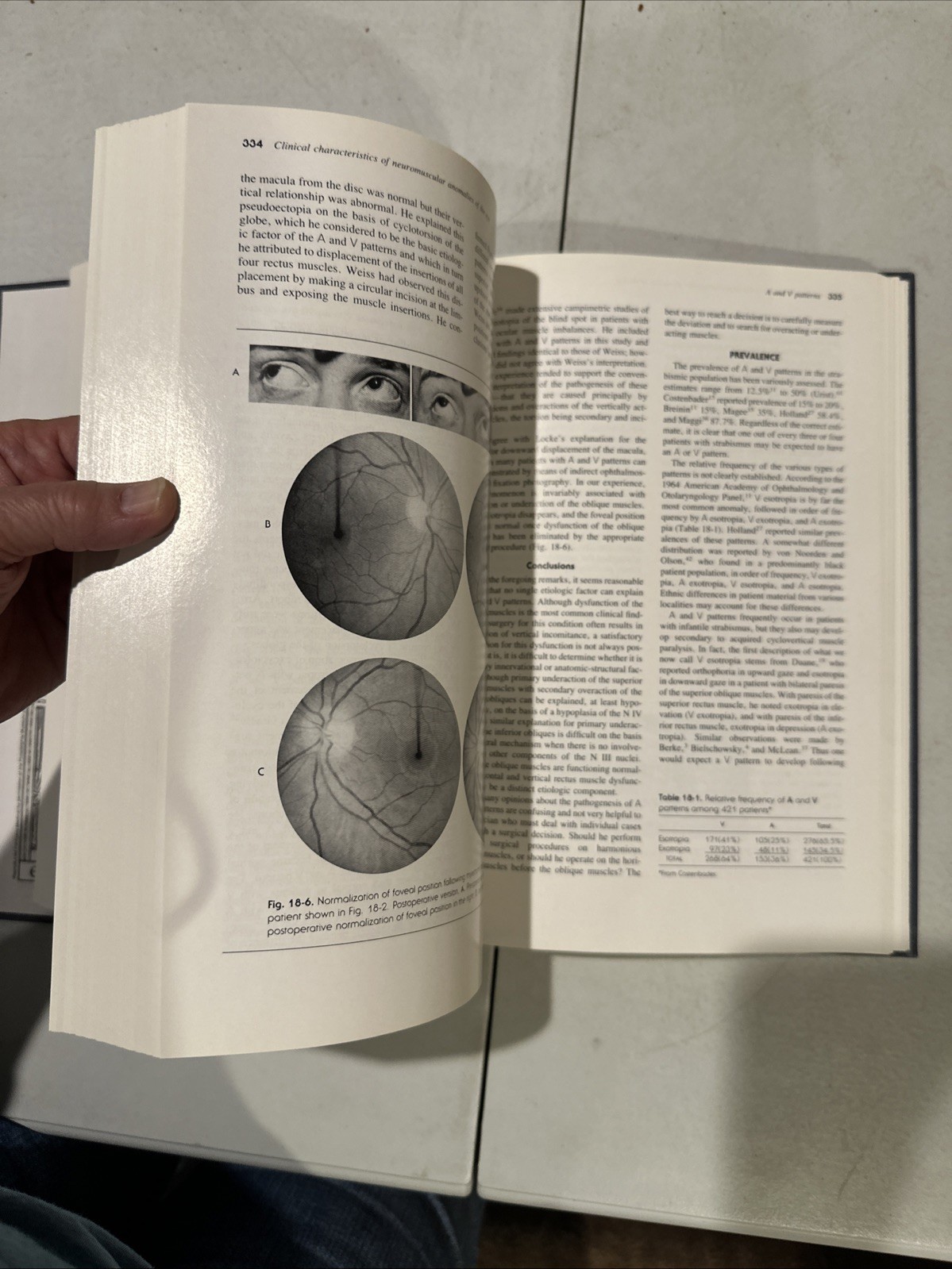 Binocular Vision And Ocular Motility. Von Noorden. 1985. Ophthalmology