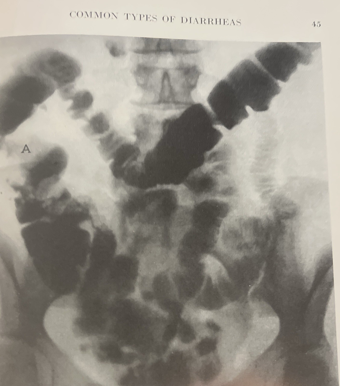 Proctoscopic Examination and Diagnosis & Treatment of Diarrheas 1940 Streicher