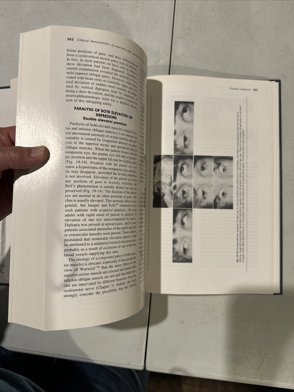 Binocular Vision And Ocular Motility. Von Noorden. 1985. Ophthalmology
