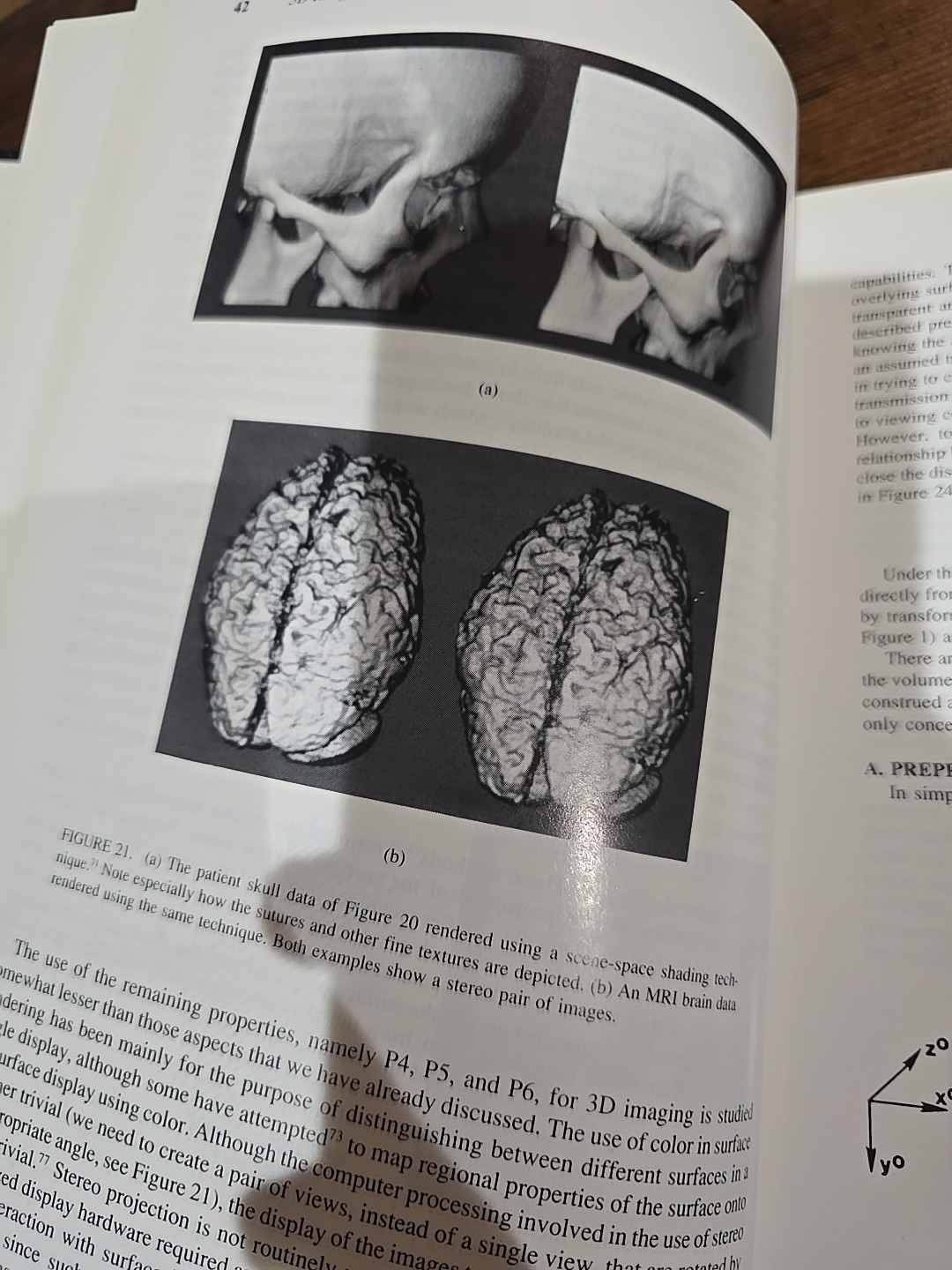 3D Imaging in Medicine – Hardcover – Jayaram K. Udupa & Gabor T. Herman – CRC…