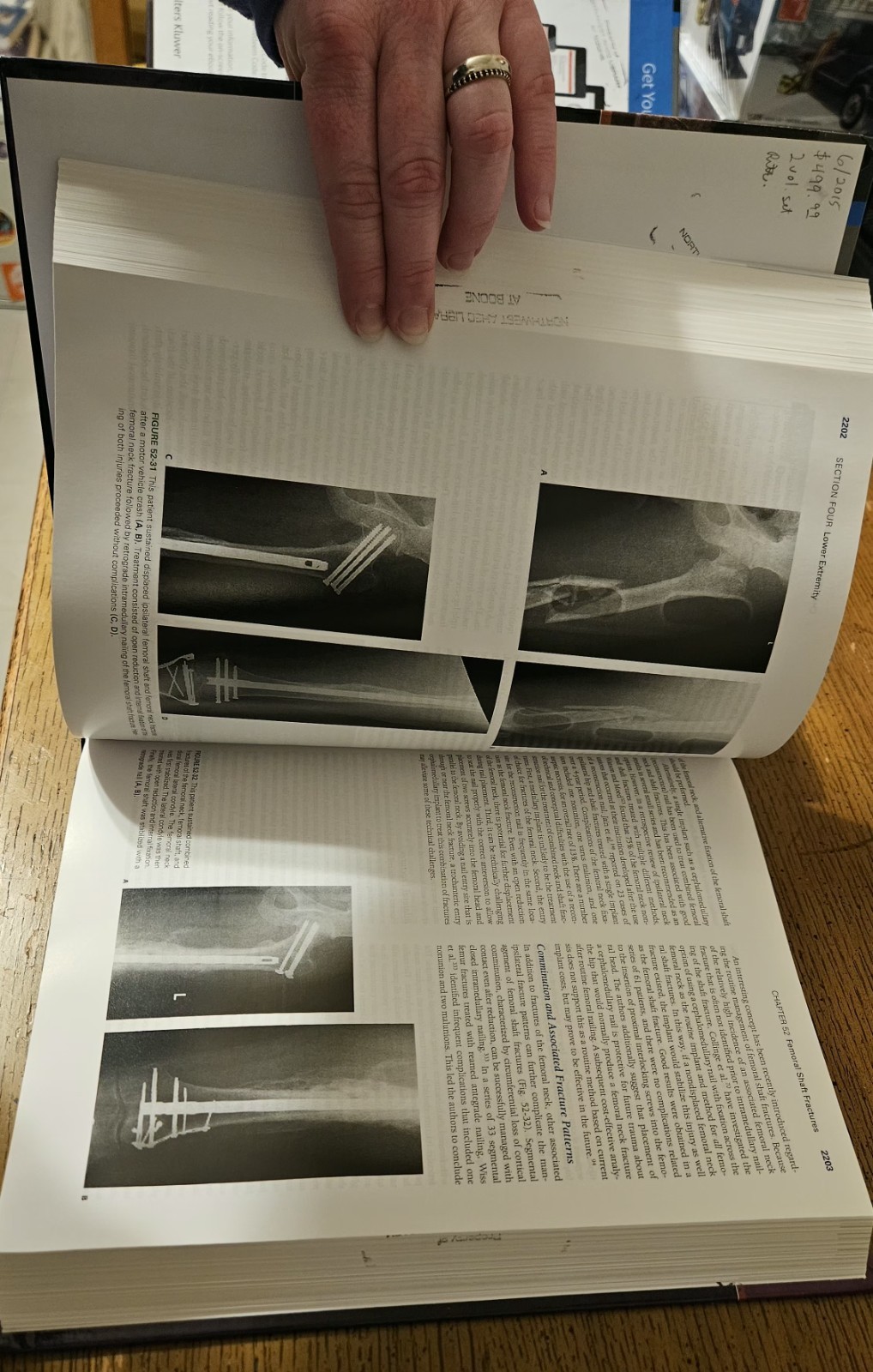 Rockwood and Green’s Fractures In Adults, Eighth Edition, Volumes 1 & 2