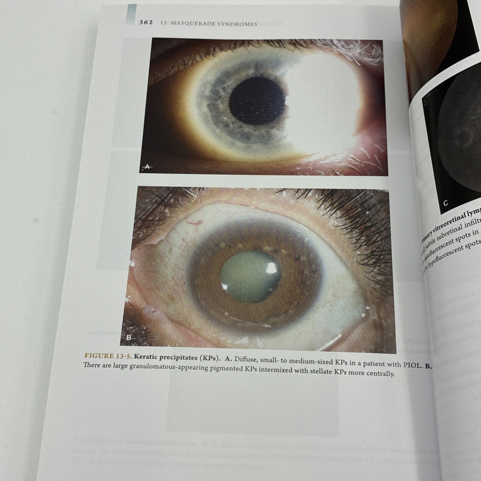 UVEITIS 2nd Edition -Rapuano Garg Color Atlas & Synopsis Ophthalmology with Code