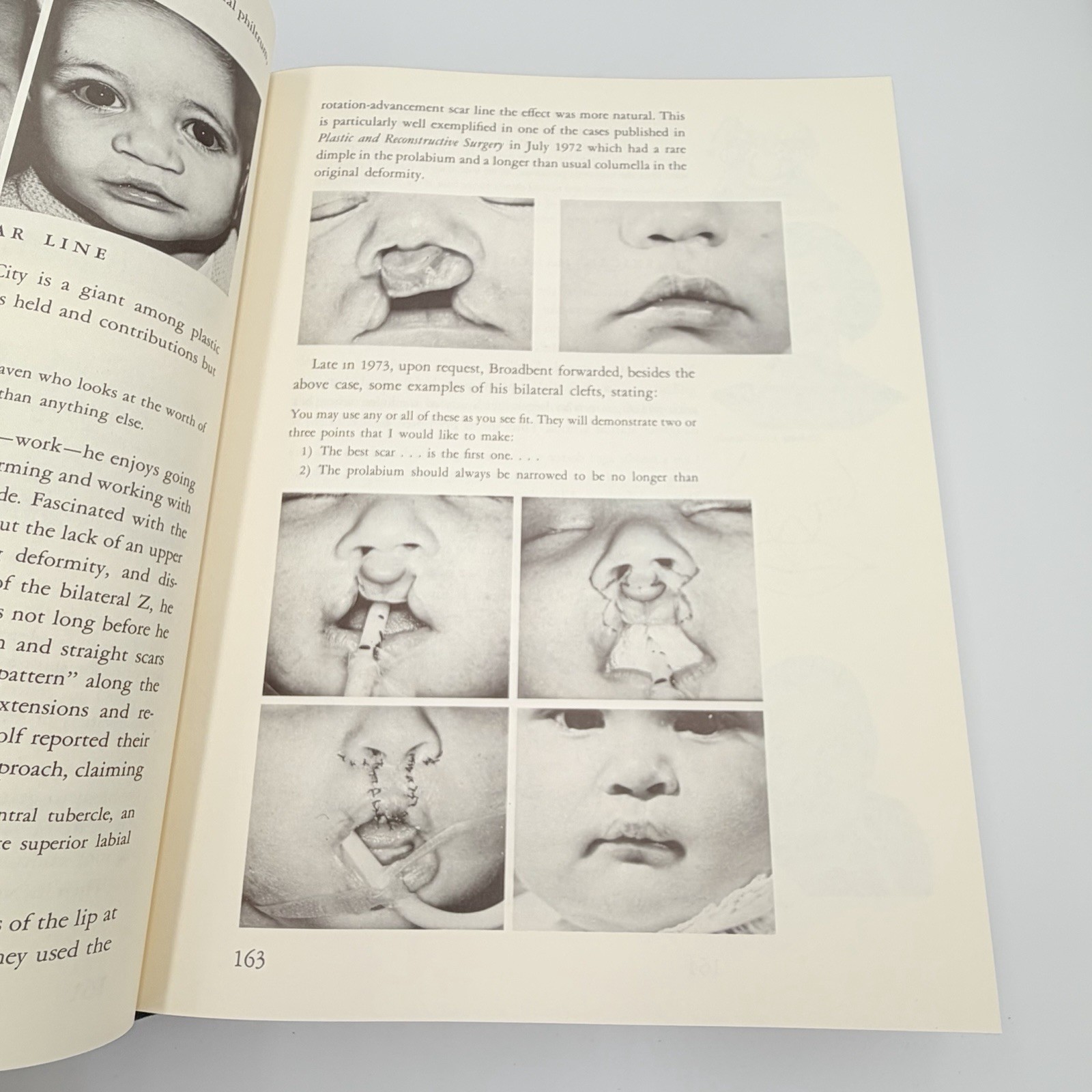 Cleft Craft Vol 2 Evolution Of Its Surgery The Unilateral Deformity Millard 1977