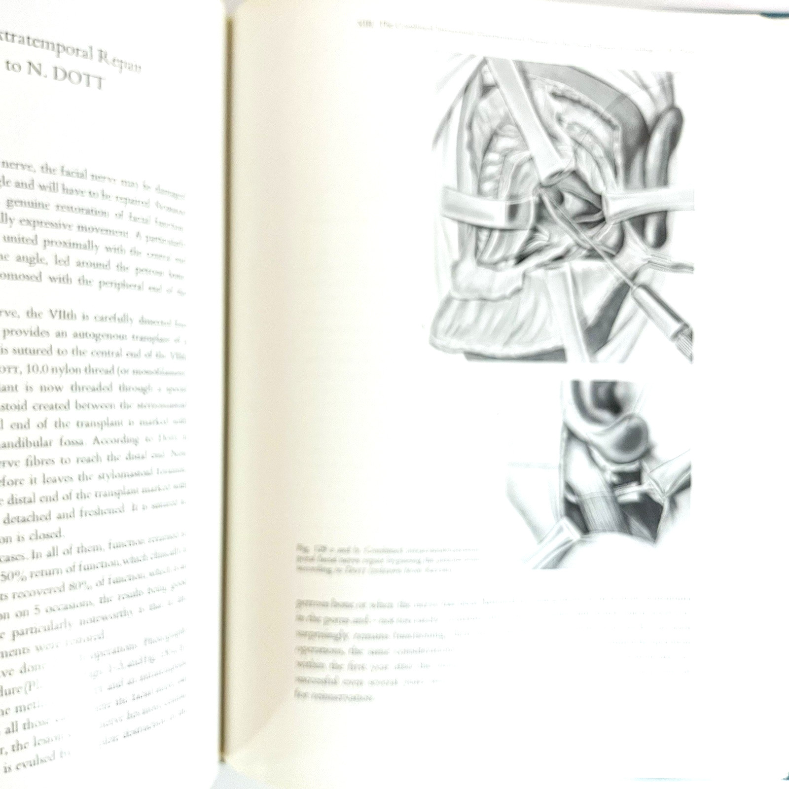 Vintage Surgery of The Facial Nerve Book Hardcover Adolf Michlke 1973
