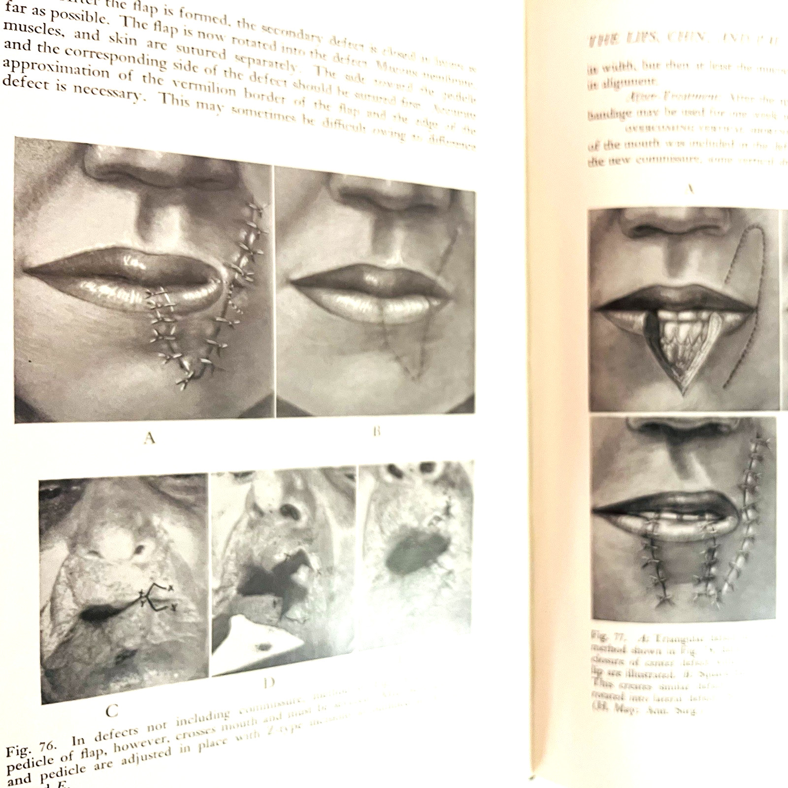 Vintage Plastic and Reconstructive Surgery 3rd Edition Book Hardcover 1971 Hans