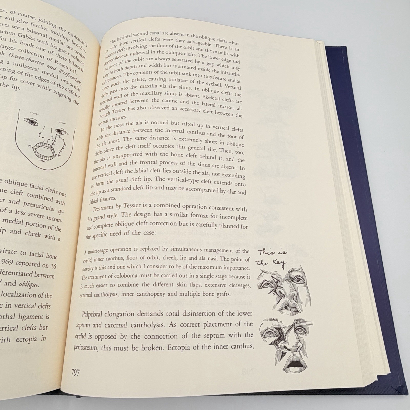 Cleft Craft Vol 2 Evolution Of Its Surgery The Unilateral Deformity Millard 1977