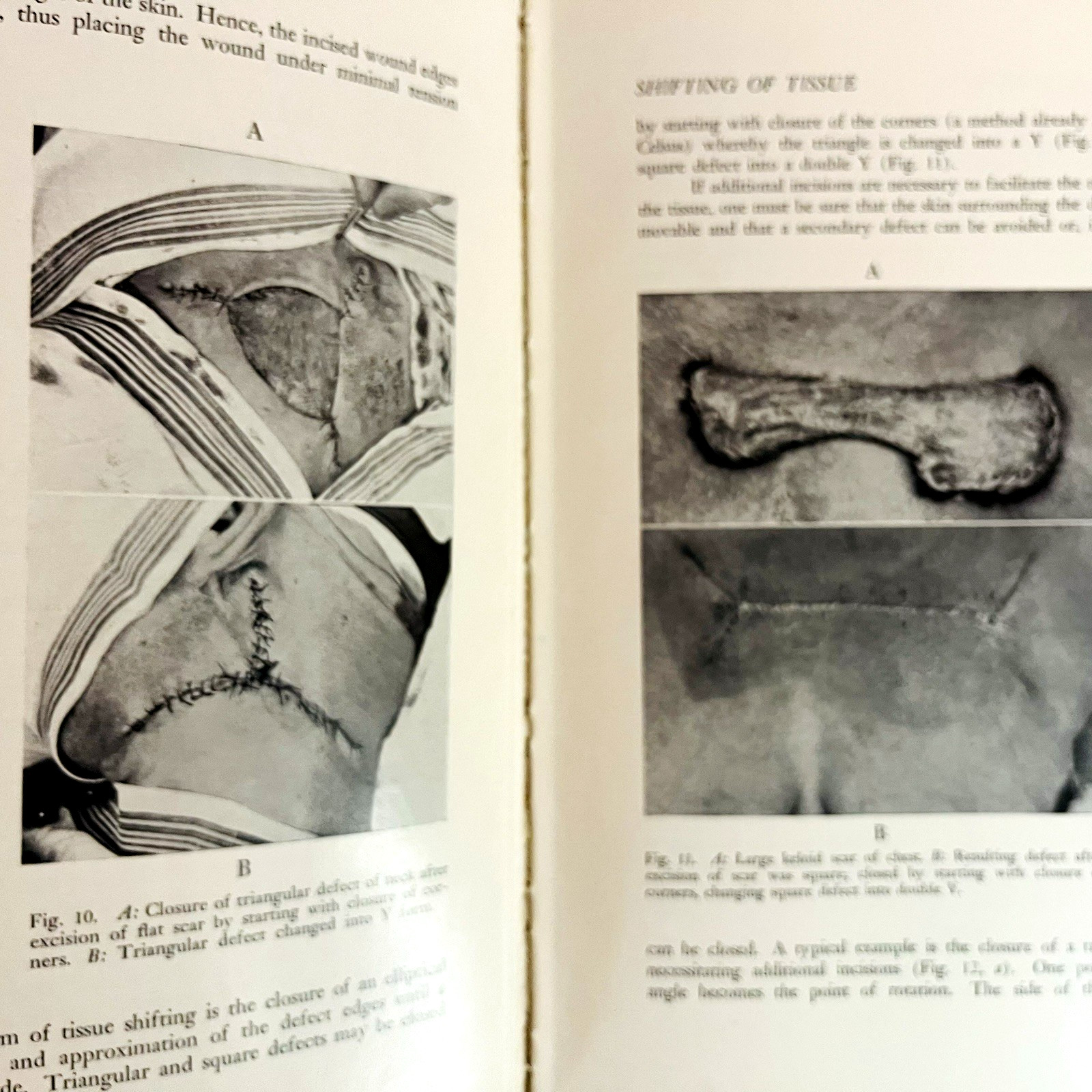 Vintage Plastic and Reconstructive Surgery 3rd Edition Book Hardcover 1971 Hans