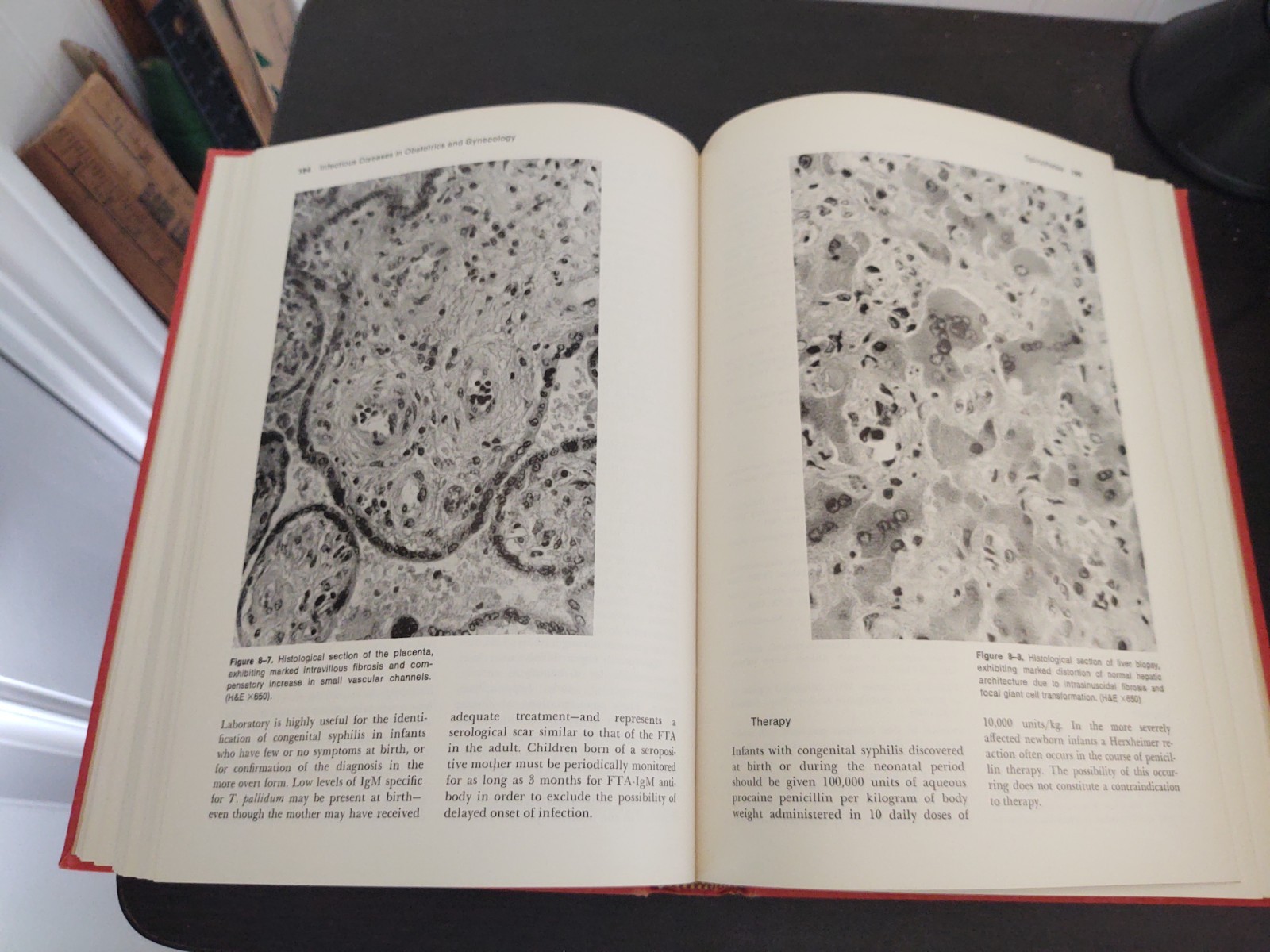 Infectious Diseases in Obstetrics and Gynecology 1974 Monif Hardcover