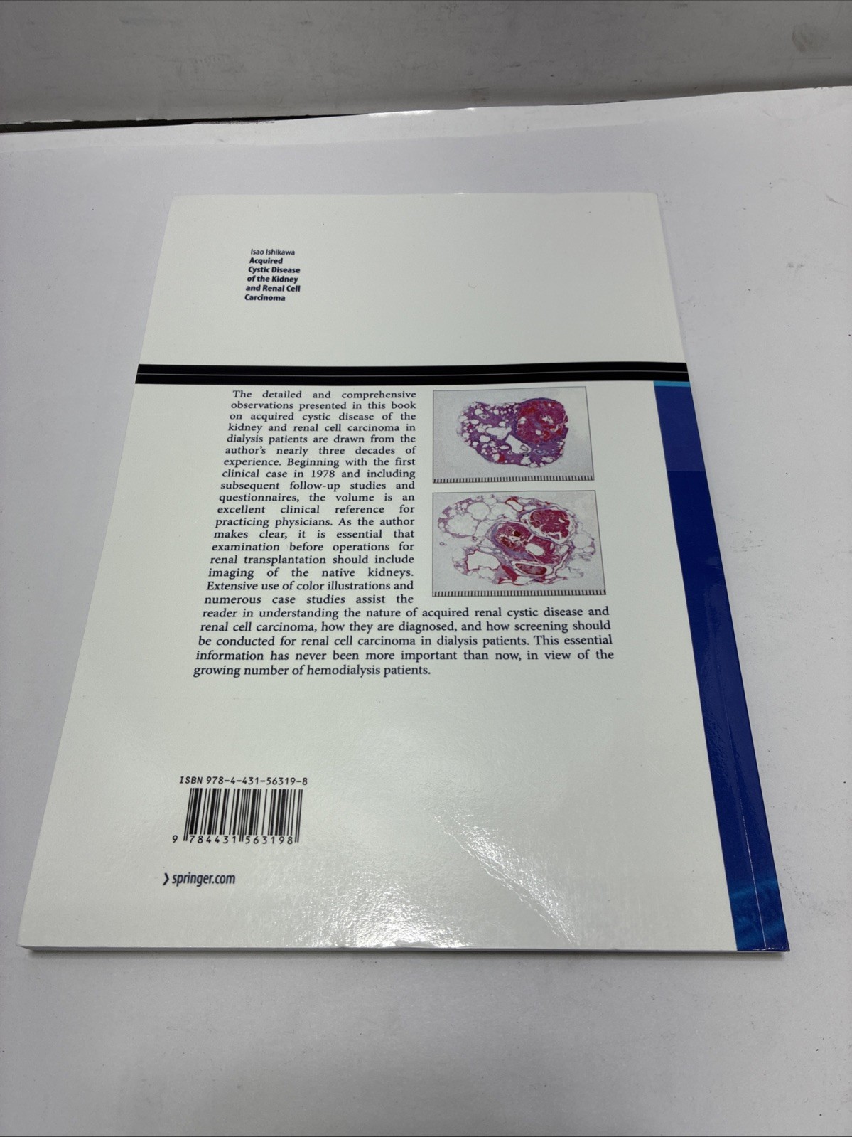 Acquired Cystic Disease of the Kidney and Renal Cell Carcinoma: Complication of