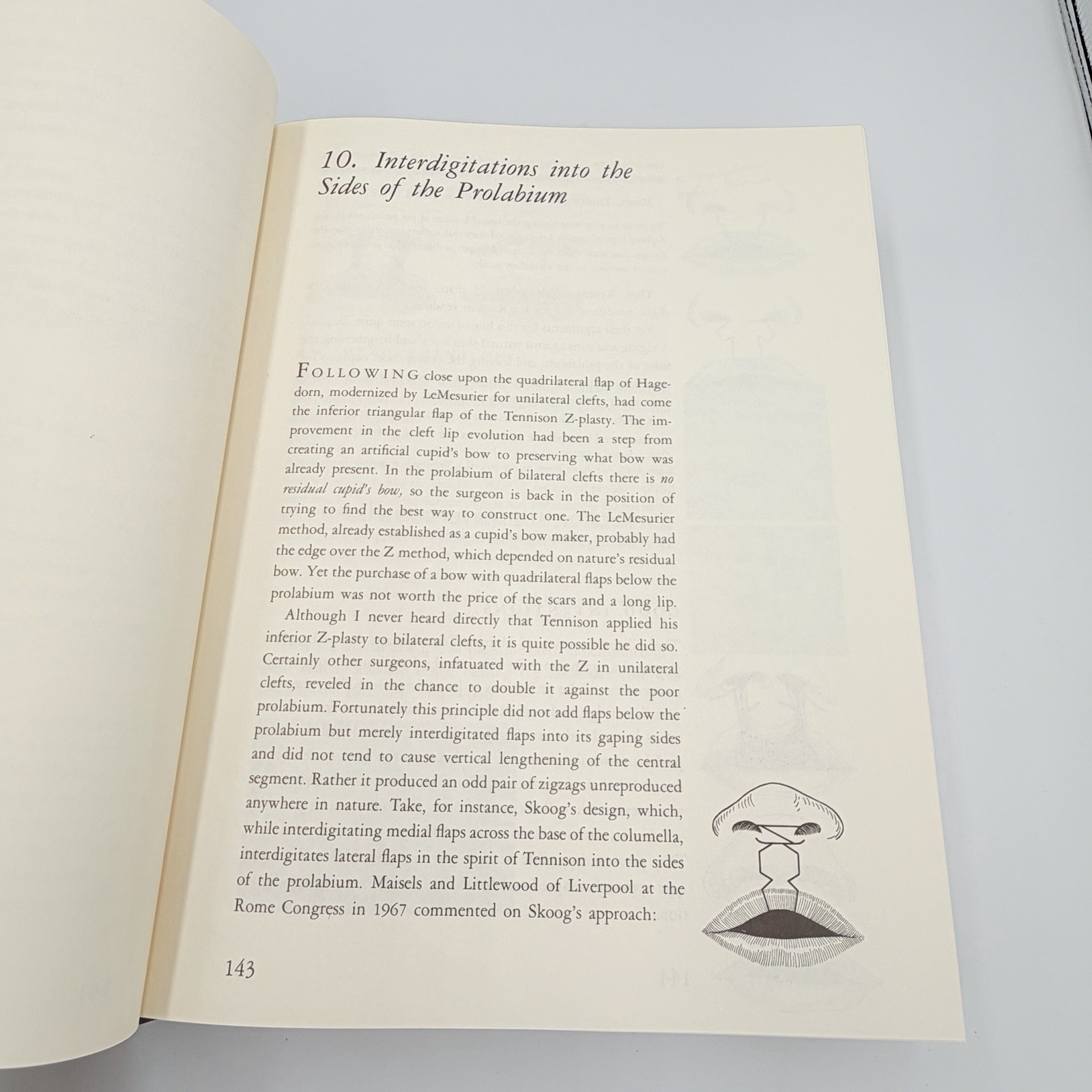 Cleft Craft Vol 2 Evolution Of Its Surgery The Unilateral Deformity Millard 1977