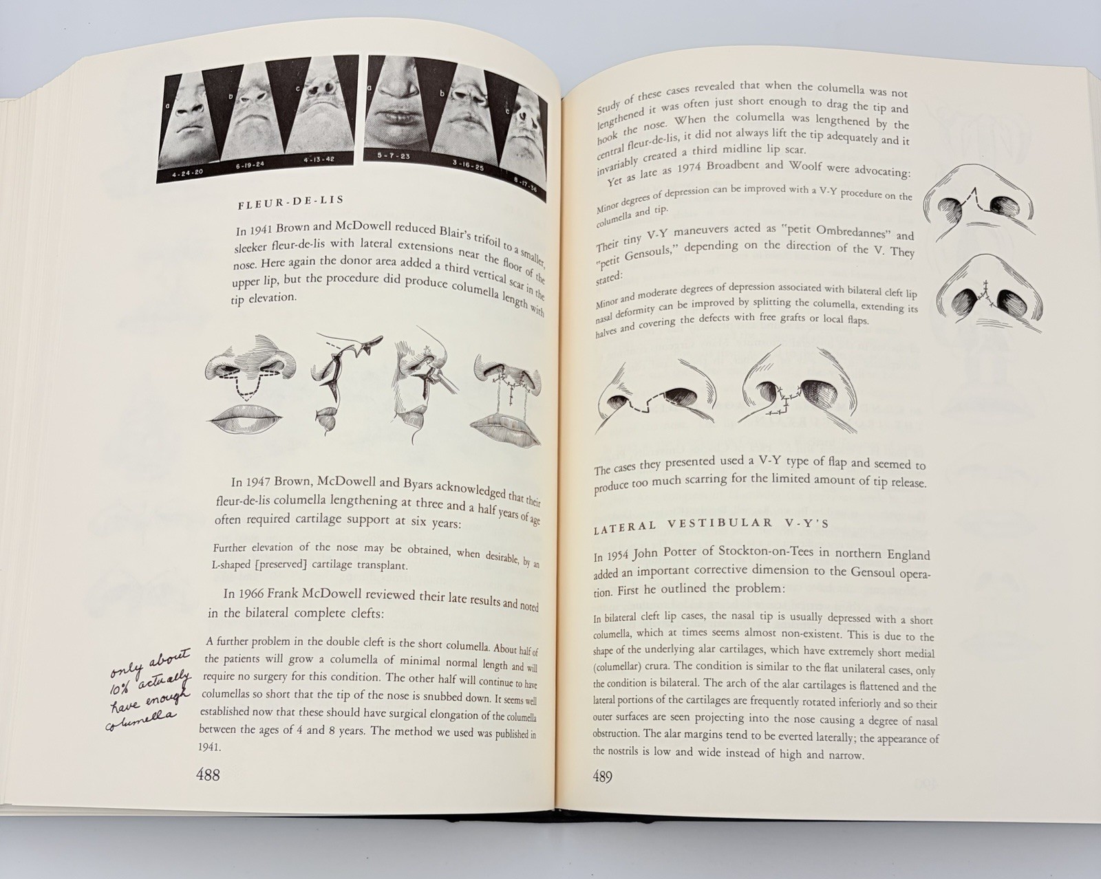 Cleft Craft Vol 2 Evolution Of Its Surgery The Unilateral Deformity Millard 1977