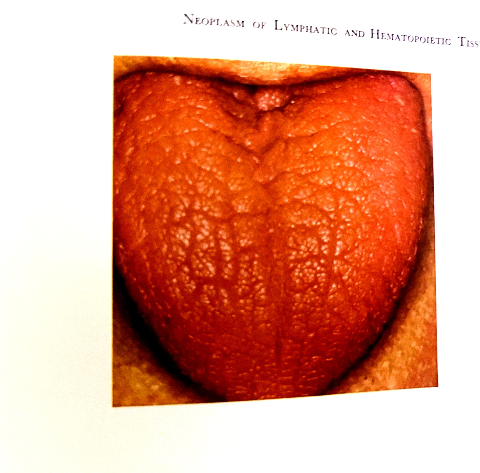 Atlas of Diseases of the Oral Mucosa Book Hardcover J. J. Pindborg 1973
