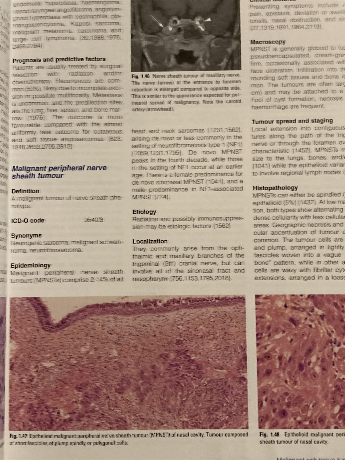 WHO Pathology and Genetics Head and Neck Tumours