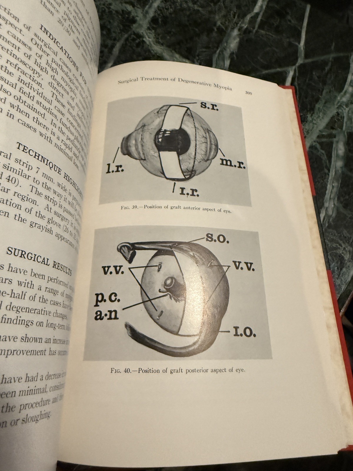 Pediatric Ophthalmology by L Byerly Holt Hardcover Book 1964 Excellent Cond