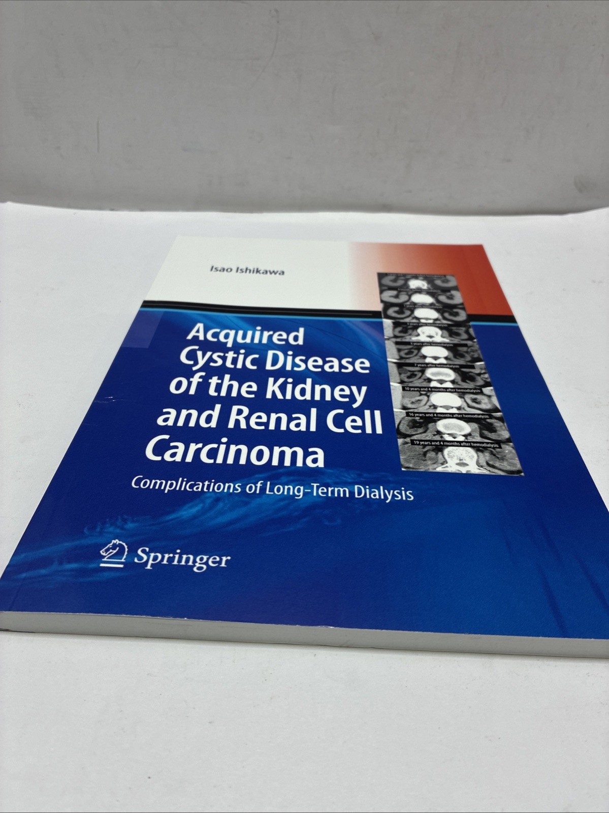 Acquired Cystic Disease of the Kidney and Renal Cell Carcinoma: Complication of