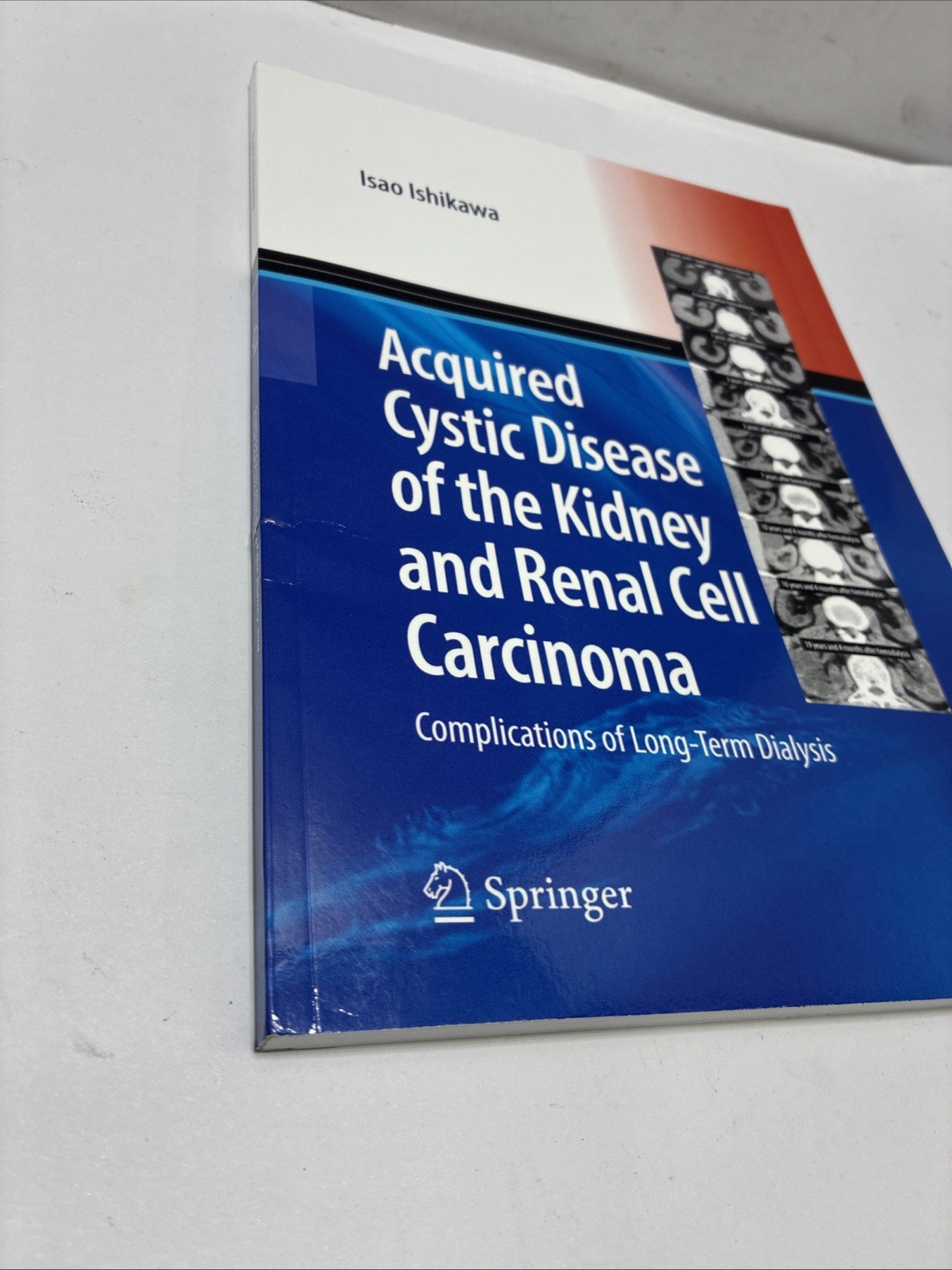 Acquired Cystic Disease of the Kidney and Renal Cell Carcinoma: Complication of