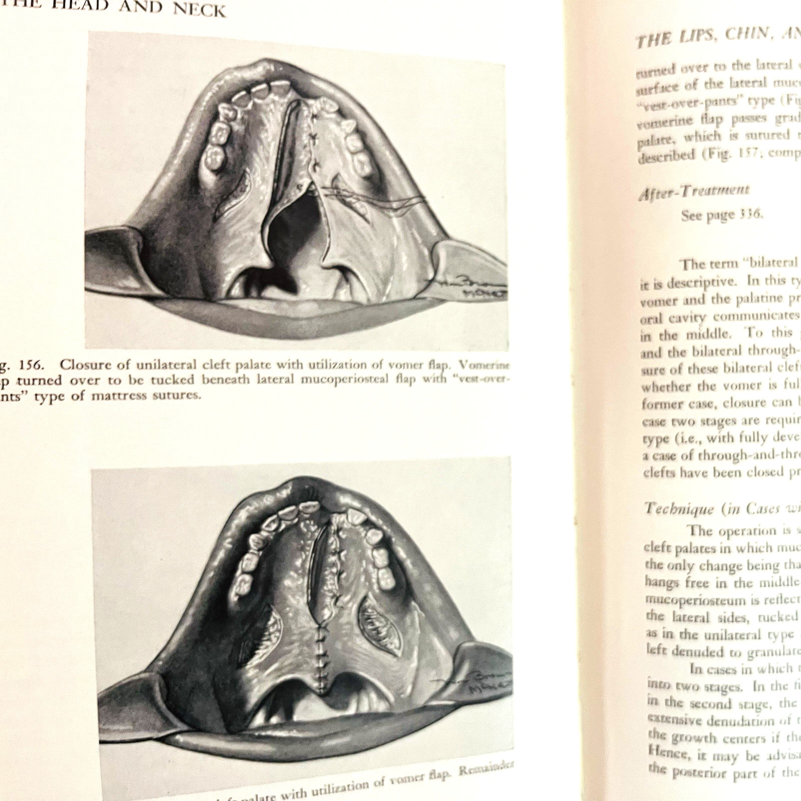 Vintage Plastic and Reconstructive Surgery 3rd Edition Book Hardcover 1971 Hans