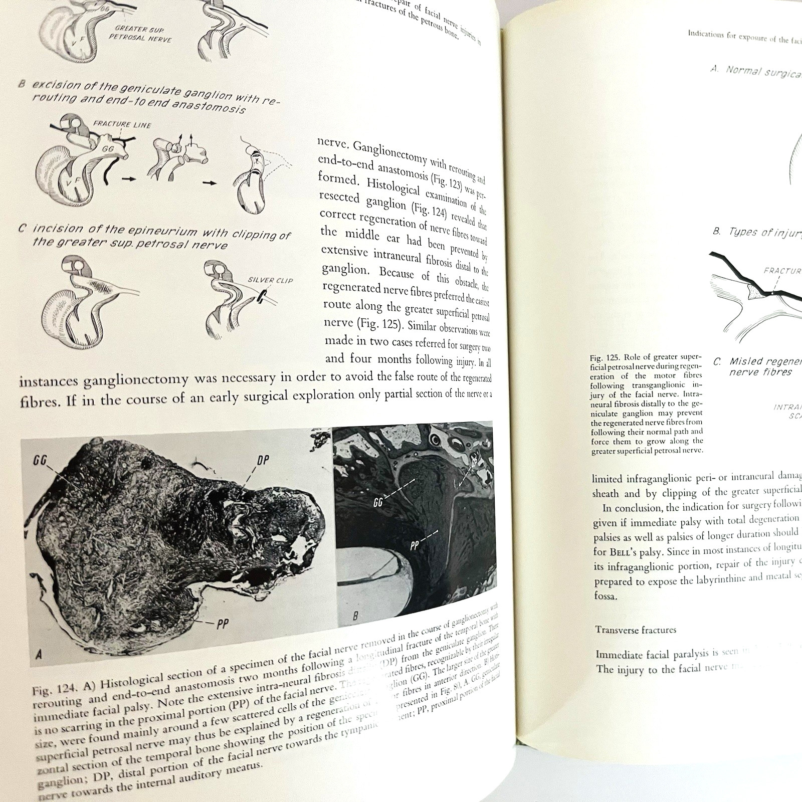 Vintage Surgery of The Facial Nerve Book Hardcover Adolf Michlke 1973